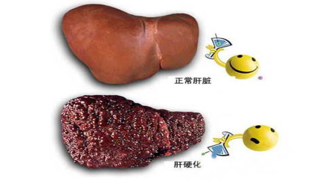 肝硬化最新治疗方法,肝硬化最新治疗方法